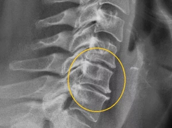 Osteohondroza vratne hrbtenice na rentgeni