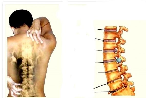 Osteohondroza je vzrok za bolečine v hrbtu