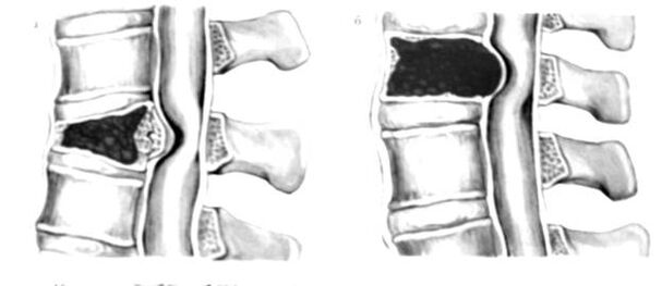 Tumor v hrbtenici je vzrok za bolečine v hrbtu